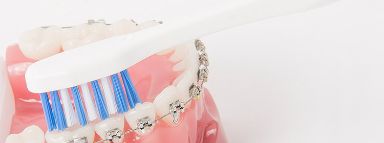 Zähne putzen mit Zahnspange