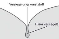 Fissurenversiegelung